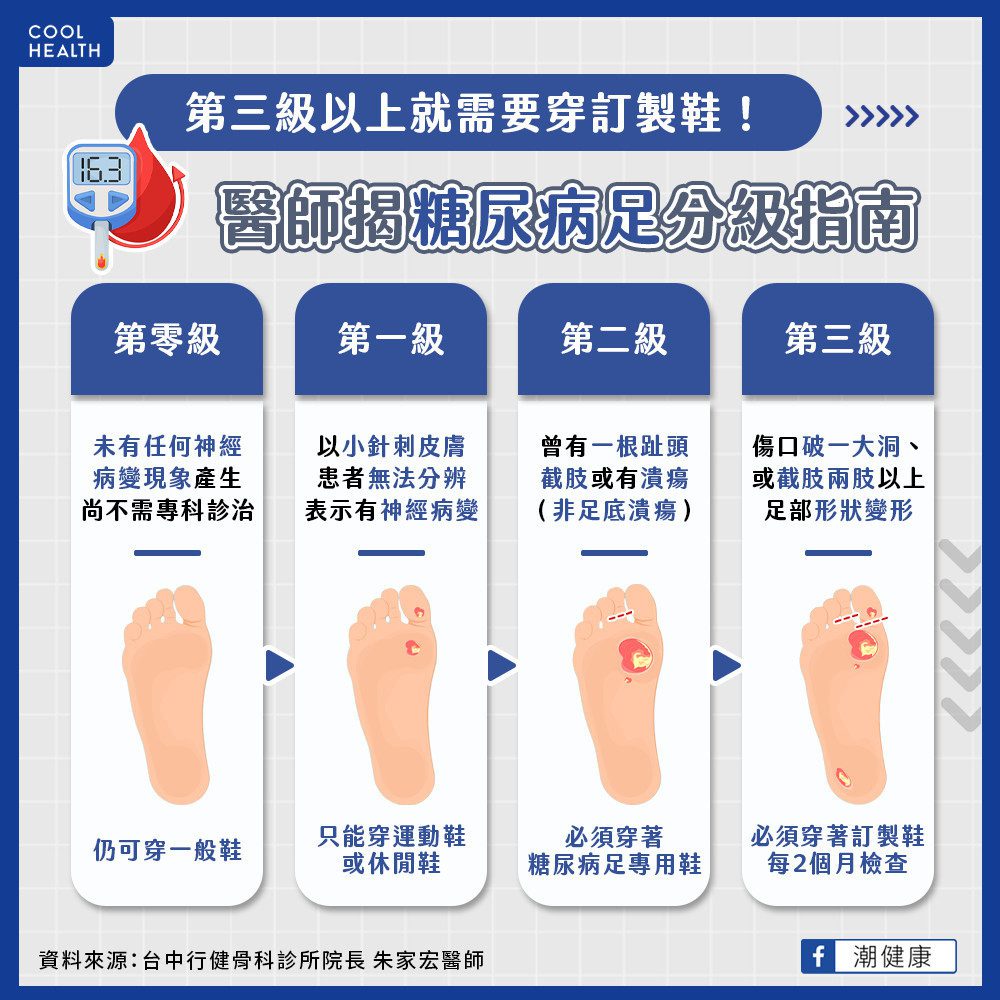 第三級以上就需要穿訂製鞋！ 醫師揭糖尿病足分級指南