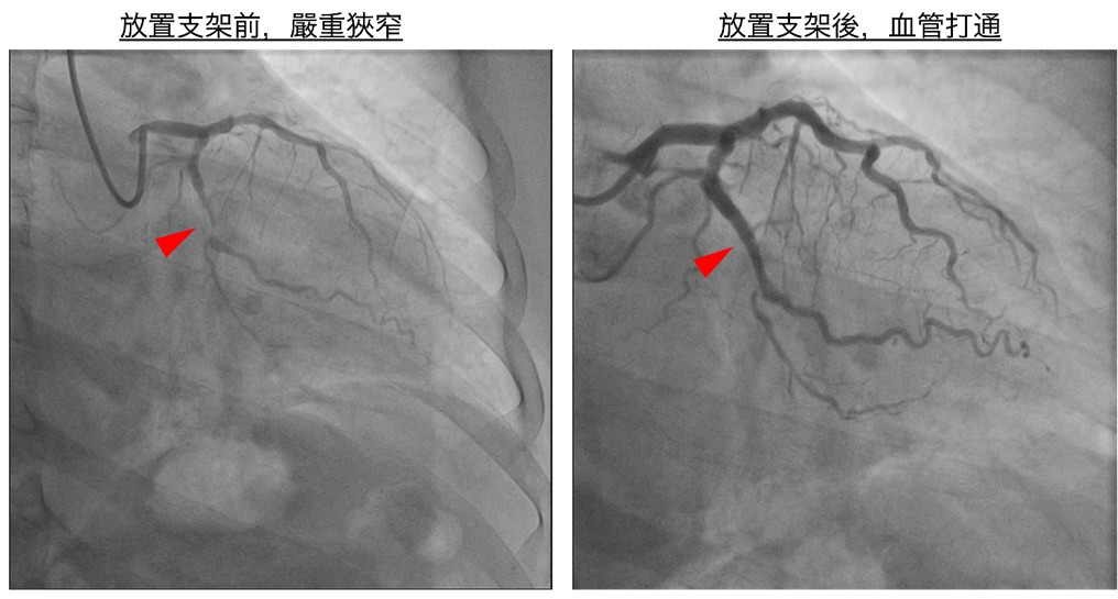 臺中市立老人復健綜合醫院(簡稱臺中市立醫院)心血管中心團隊醫師：心臟內科主任簡思齊(左)、心臟內科暨導管室主任鍾偉信(右)與患者合影。