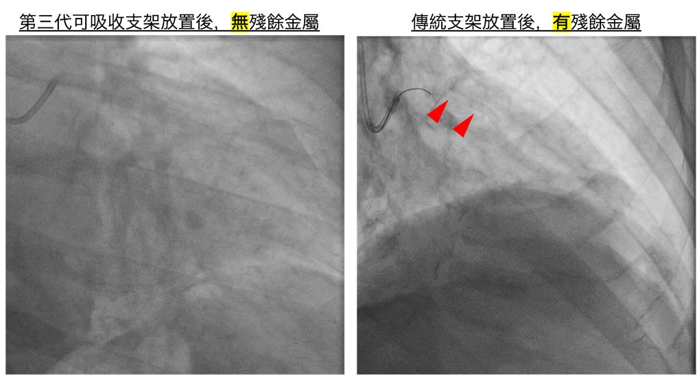 放置第三代可吸收支架，一年內約99%會被身體吸收，不會殘留異物或造成長期發炎。(非患者本人)