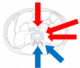 手術以間接減壓的方式，從後腹腔進入(紅色箭頭)，有別傳統從脊椎腔(藍色箭頭)切入，因此能夠不破壞骨骼不撥弄脊椎神經，大幅減低神經損傷機率。