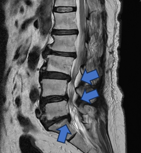 【手術前及手術後】手術前有脊椎滑脫不穩定及脊椎狹窄造成神經壓迫(左圖)。手術後除了重建椎間高度，也將腰椎的生理曲線重建為較理想的前凸狀態(右圖)。