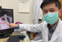 男子低血糖反覆發作竟非糖尿病 多次昏迷送醫揪出25公分罕見肺腫瘤