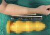 不小心?59歲男直腸塞進28公分異物頂到肺 醫師爆:上次是南瓜
