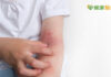 慢性發炎+搔癢難眠恐阻長高 異膚兒積極治療護膚又改善發育