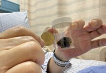 3公分膽結石沒事 0.5公分總膽管結石竟爆致命危機